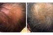 Up to 60% Off on Hair Restoration - Non-Surgical at Mar Essence - Second Medium