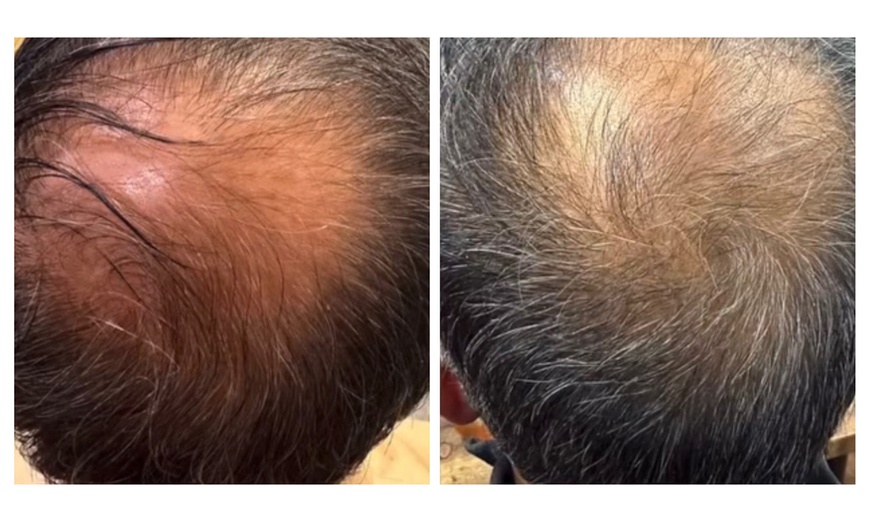 Image 4: Up to 70% Off on Hair Restoration - Non-Surgical at Mar Essence
