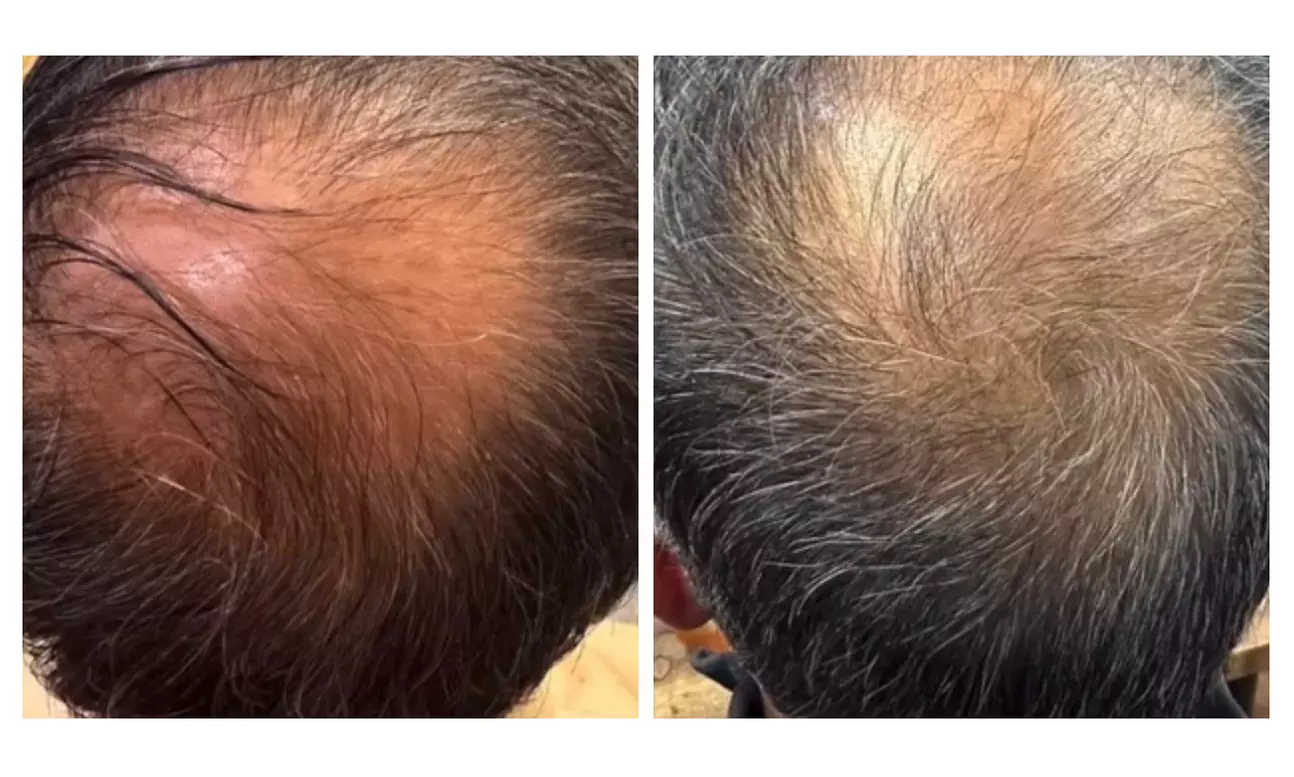 Transform Your Hair with One Single Session of TED Hair Restoration