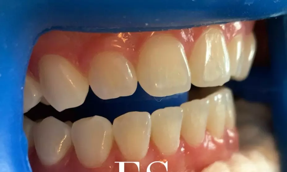 Experience Enlightened Teeth Whitening with options for 30 or 60 minute sessions, offering up to 46% off for a radiant smile - Second Medium