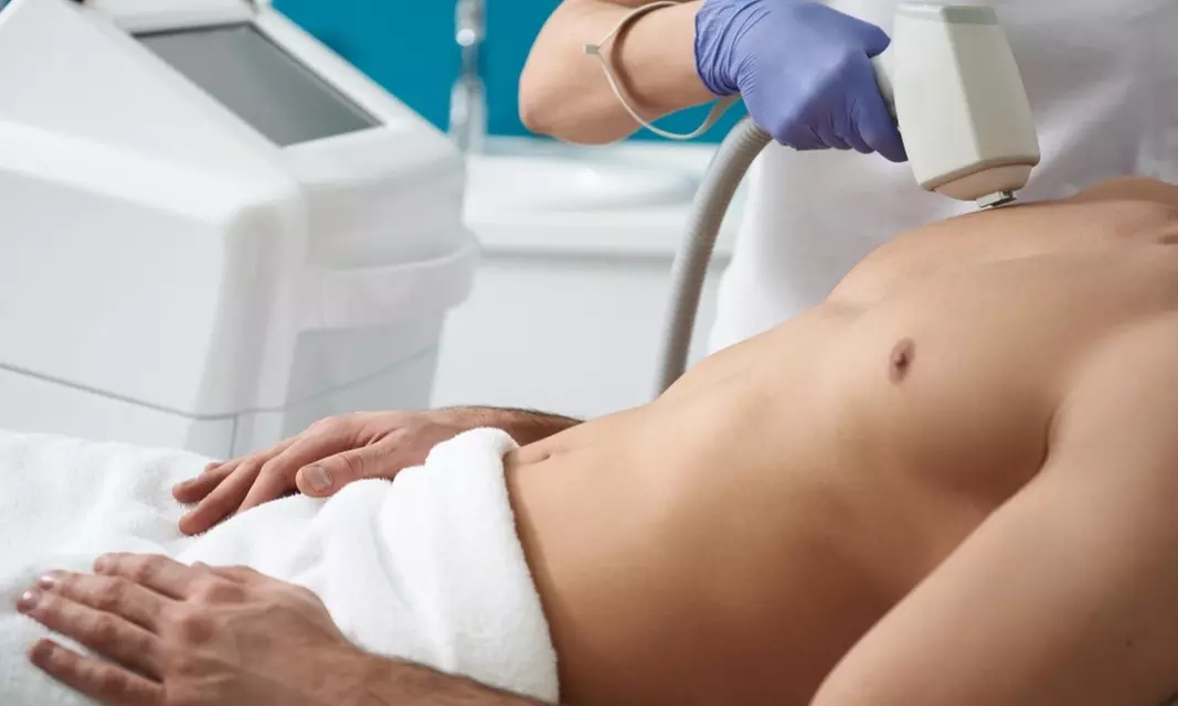 1, 3 o 6 sesiones de depilación con láser de diodo para hombre