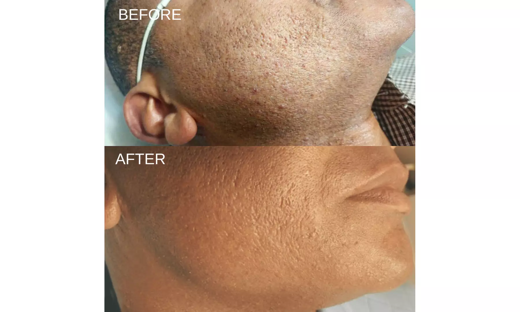 8 Laser Hair Removal Sessions on One Extra Small, Small, Medium & More