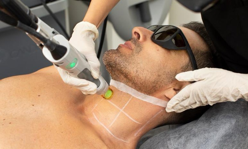 Image 5: Up to 90% Off on Laser Hair Removal at Gentle Zap Laser Med Spa