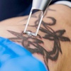 Image 1: Erase That Ink: One or Three Tattoo-Removal Sessions
