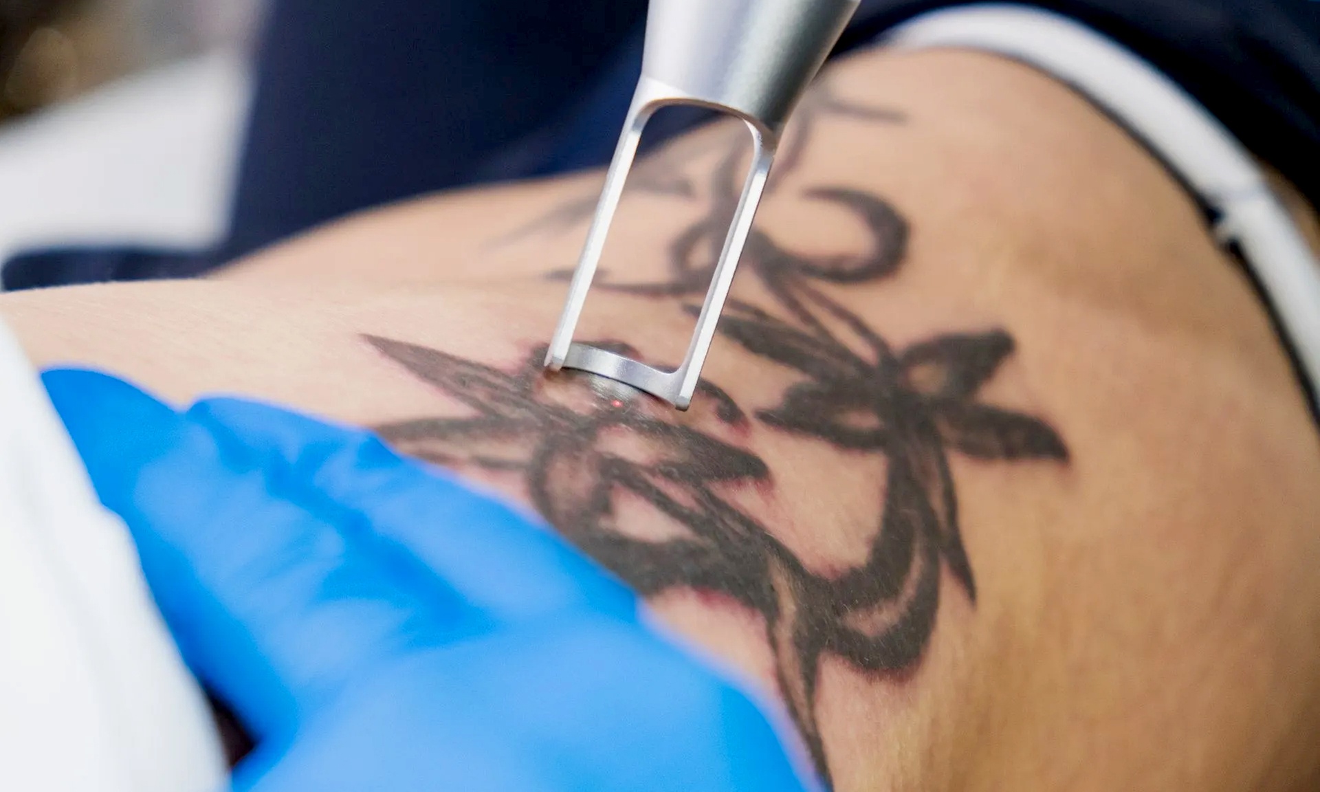 Erase That Ink: One or Three Tattoo-Removal Sessions
