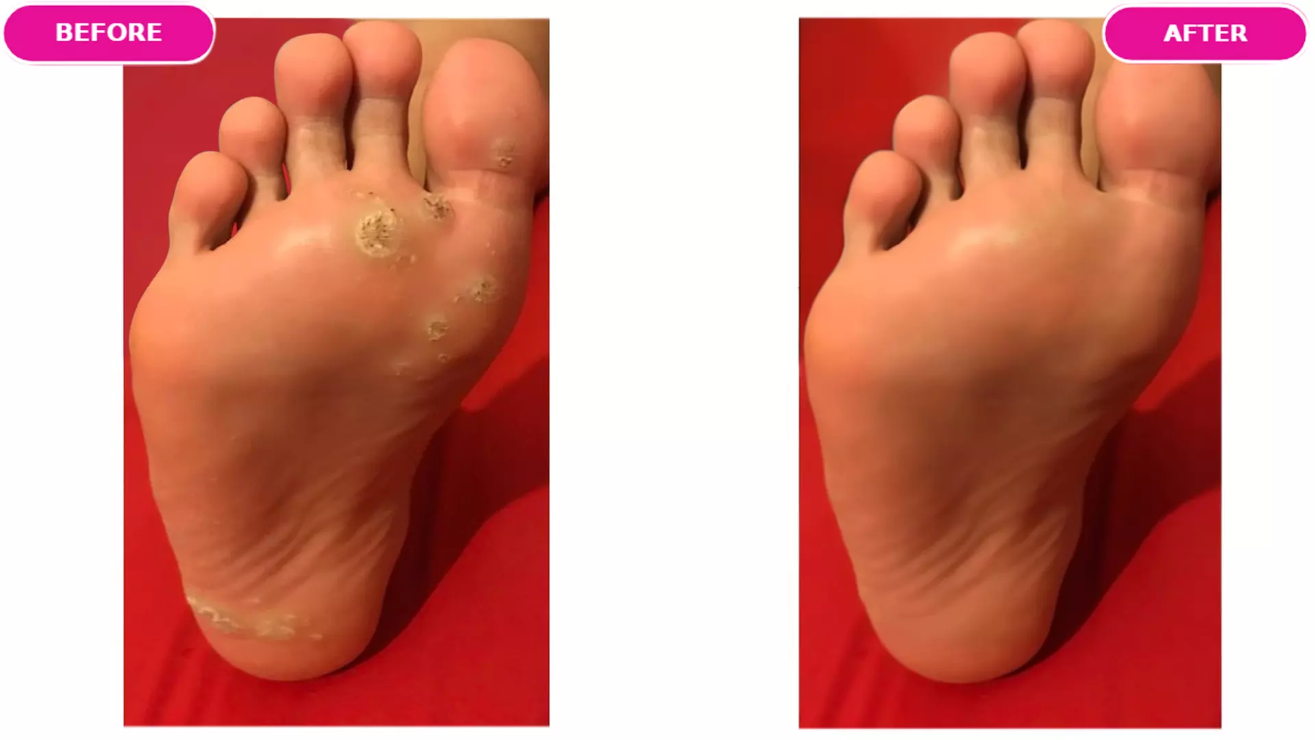 Expert Treatment of Up to 3 Warts or Verrucas (Up to 84%)