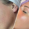 Image 1: IPL Photofacial Treatments for Pigmentation and Redness