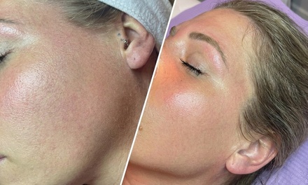 IPL Consultation + Targeted Treatment - H.S. Medical Aesthetics & Wellness Center