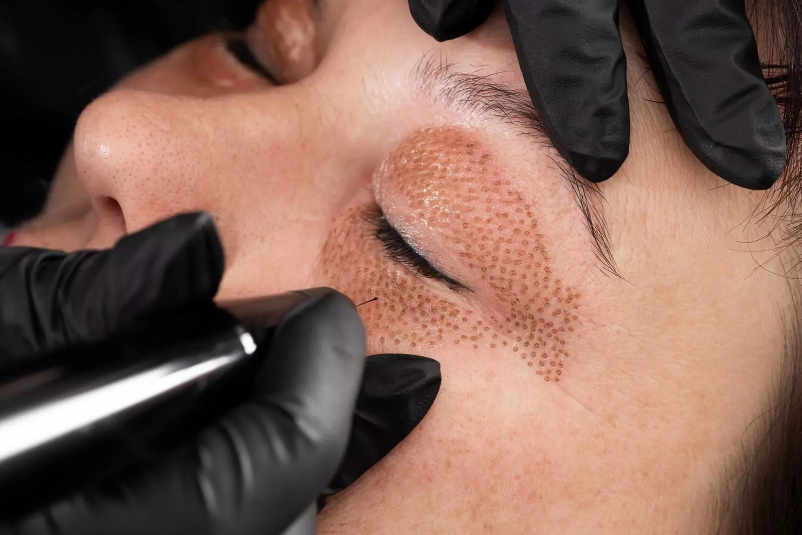 Plasma Lift Smokers Lines, Forehead, Crows Feet or 11's at 6 Senses Dermacare(Up to 55% Off) - Second Medium