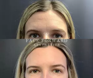 Up to 29% Off Botox and Juvéderm at Face Forward Aesthetics