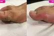 Professional Cryosurgery Treatment of Up to 3 Warts or Verrucas on Hands or Feet (Up to 84%) - Image 2