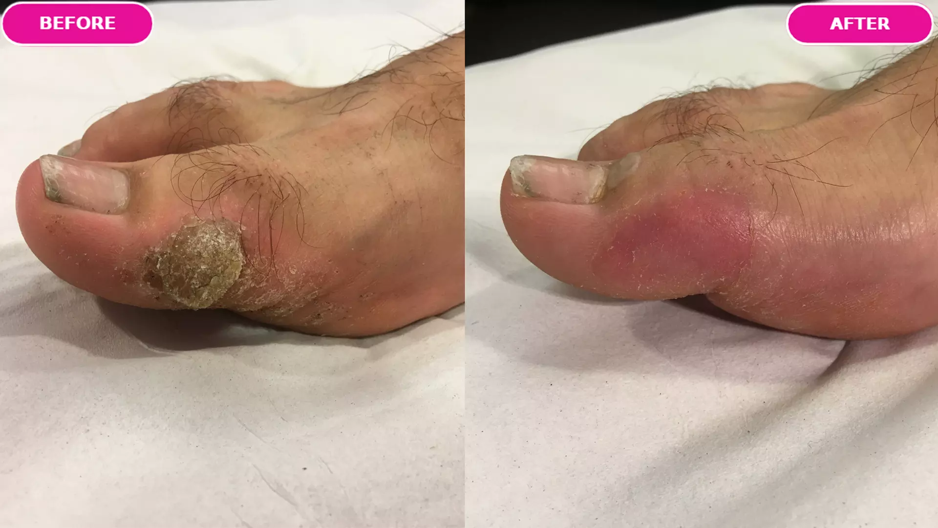 Expert Treatment of Up to 3 Warts or Verrucas (Up to 84%)