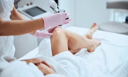 One Spider Vein Removal Session for Two Areas - FrescoMD laser and skin clinic