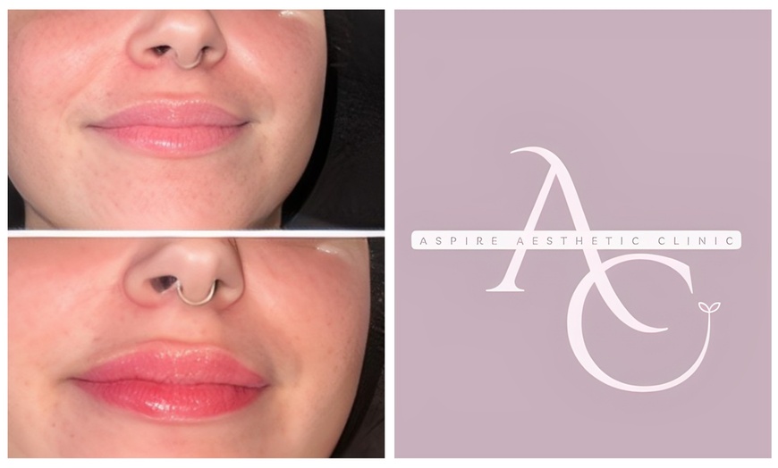 Image 2: Enhance your Lips with Expert Dermal Filler Treatments in Wembley!