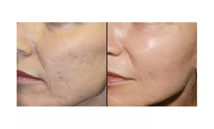 Choose From Micro-Needling or Dermaplaning Treatments for Glowing Skin