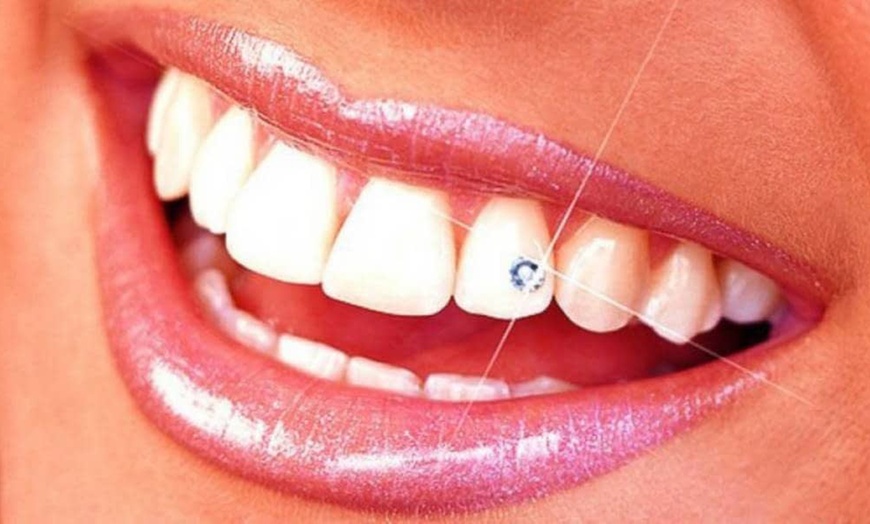 Image 6: Colocación de 1 o 2 brillantes dentales no invasivos para 1 persona