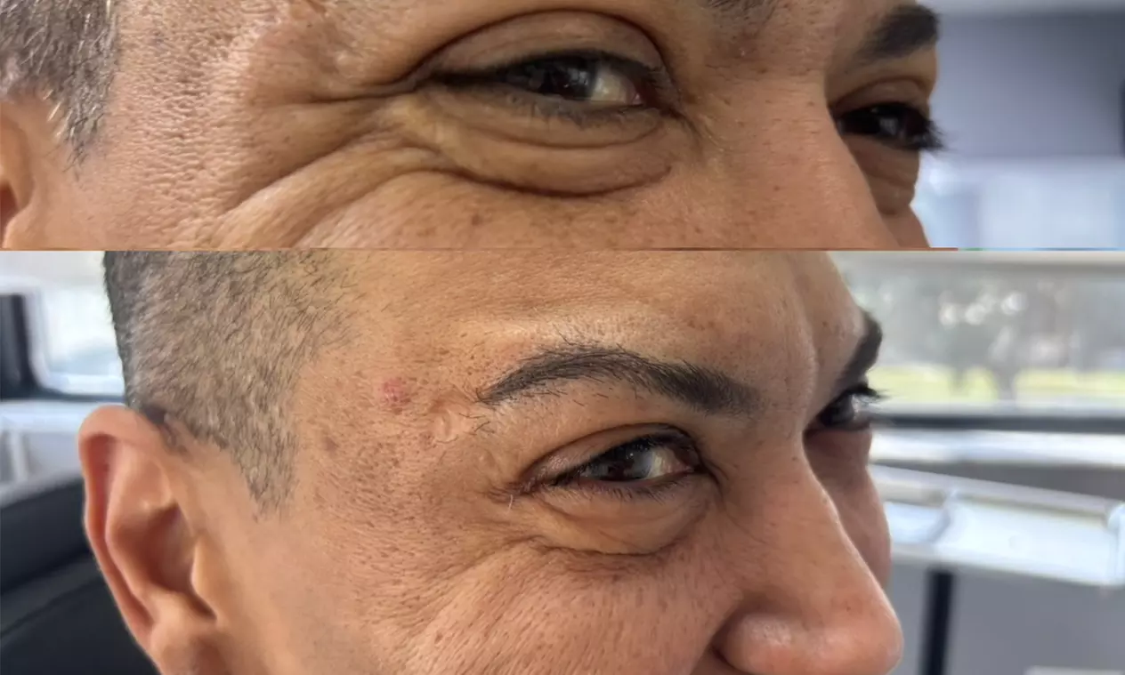 Revitalize with 20, 40, or 60 units Units of Jeuveau