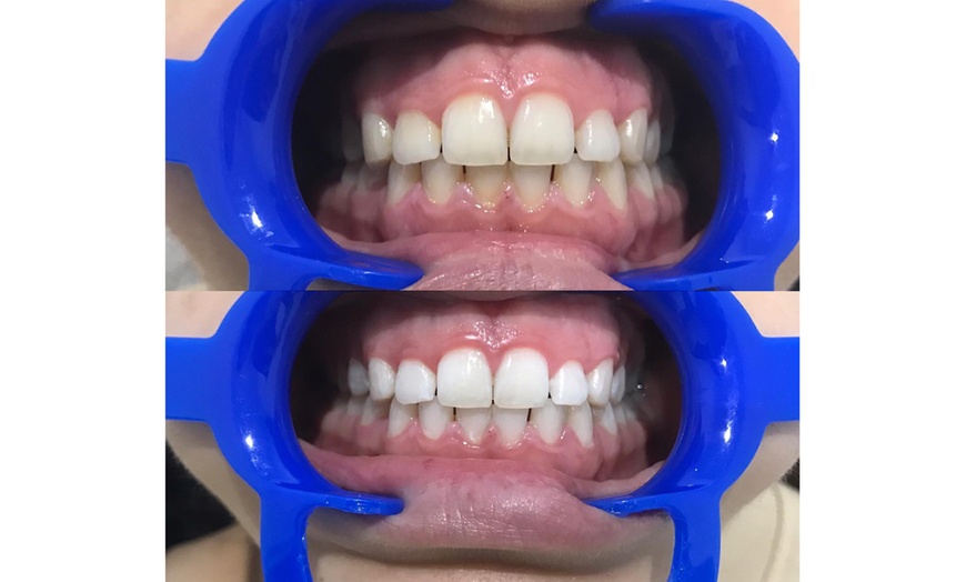 Image 4: Teeth Whitening Treatment