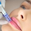 Image 14: Sesiones de rehidratación de labios o microlifting facial con Dermapen