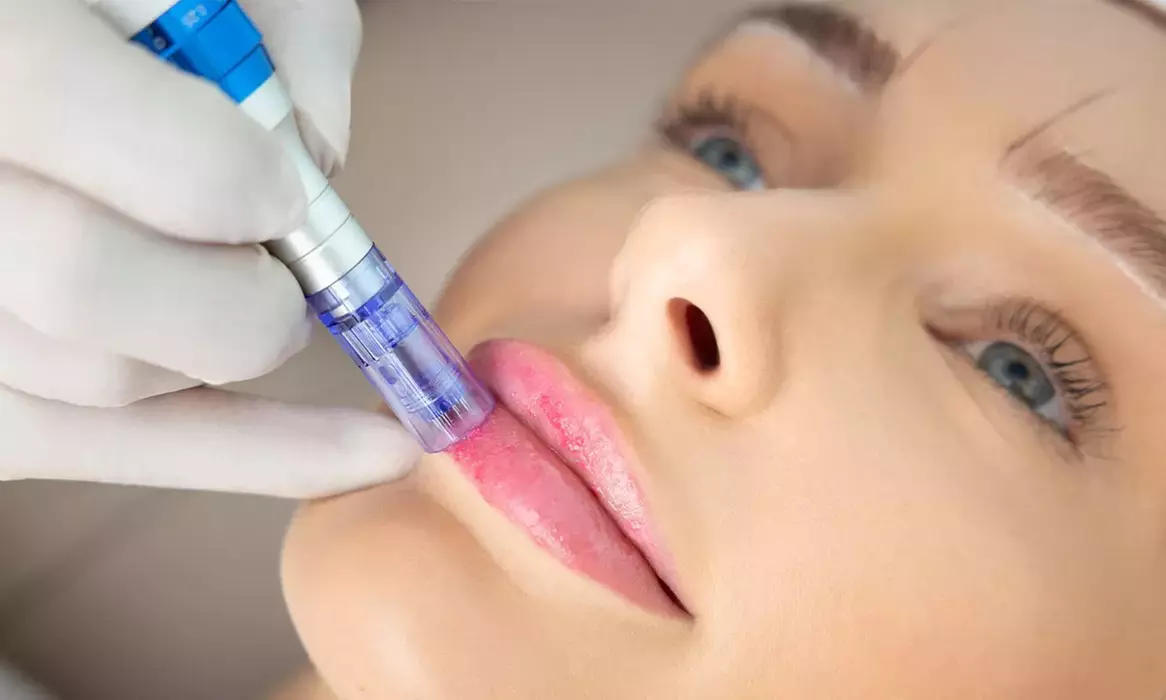Sesiones de rehidratación de labios o microlifting facial con Dermapen