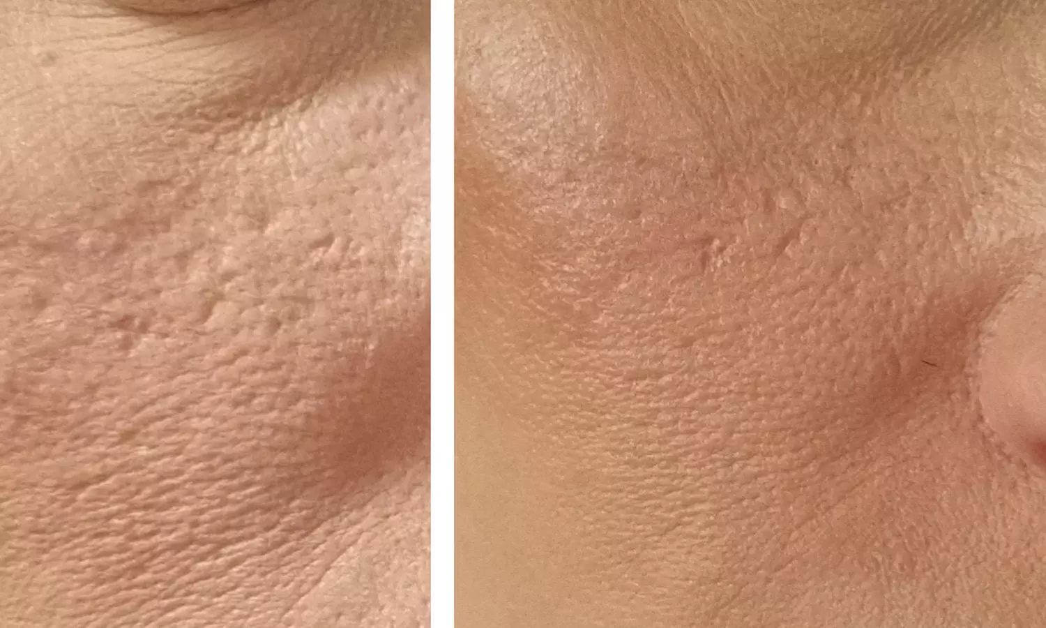 Enhance Skin with Micro-Needling Using Collagen or PRP