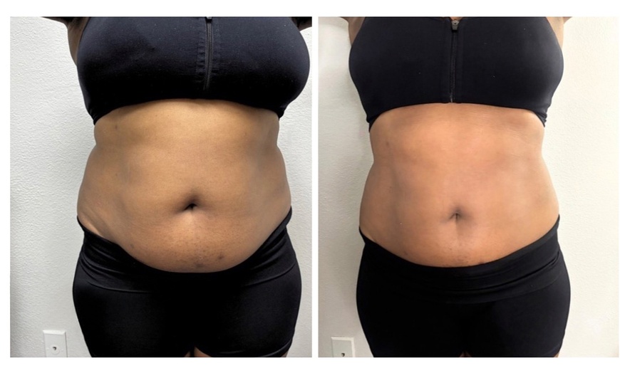 Image 3: 60- or 90-Min Body Contouring for One or Multiple Areas
