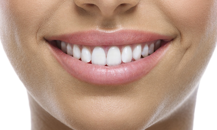 Image 1: 75% Off Teeth Whitening