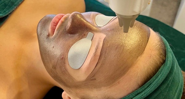 Laserowy peeling węglowy i spersonalizowana maska