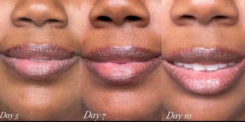 Up to 53% Off on Lip Enhancement at Jm Aesthetica - Second Medium
