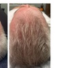 Image 3: Fuller & Healthier Scalp: 2, 4, or 6 Procell Hair Restoration Sessions