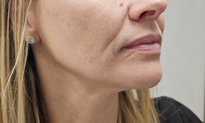 Image 6: Revitalize Your Skin with IPL Photofacial Treatments