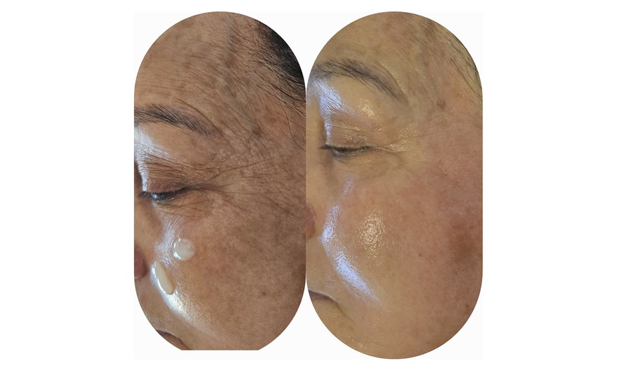 Image 6: Aqua-Facial- & Microneedling-Gesichtsbehandlung für 1 Person