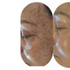 Image 6: Aqua-Facial- & Microneedling-Gesichtsbehandlung für 1 Person