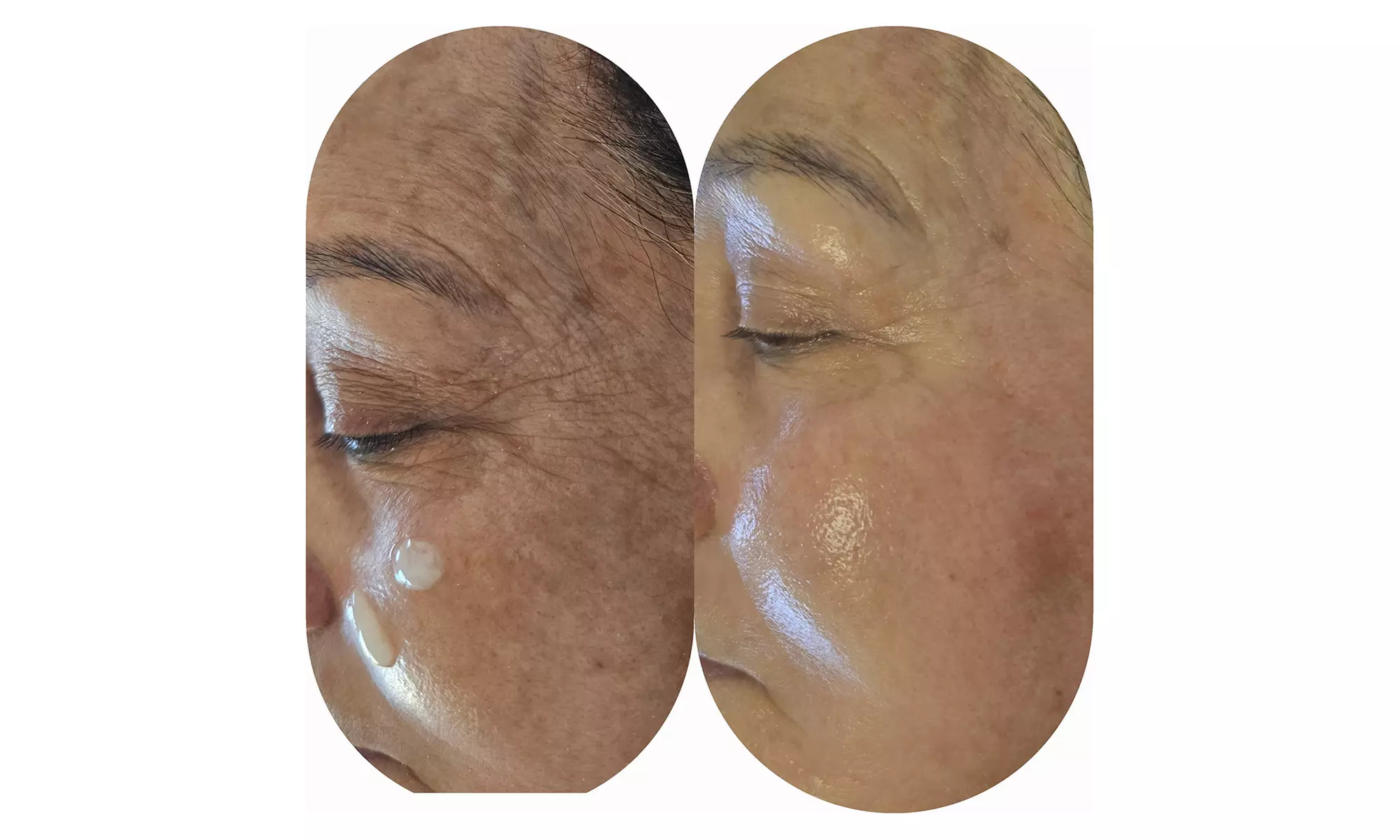 Aqua-Facial- & Microneedling-(Fadenlifting-)Gesichtsbehandlung für 1 Person (bis 68% sparen) - Second Medium