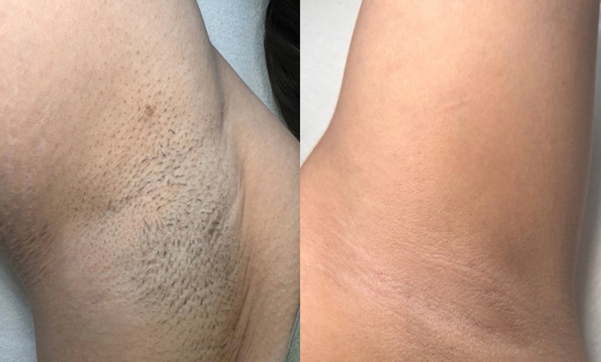 Image 2: Diodenlaser-Haarentfernung an verschiedenen Zonen für 1 Person