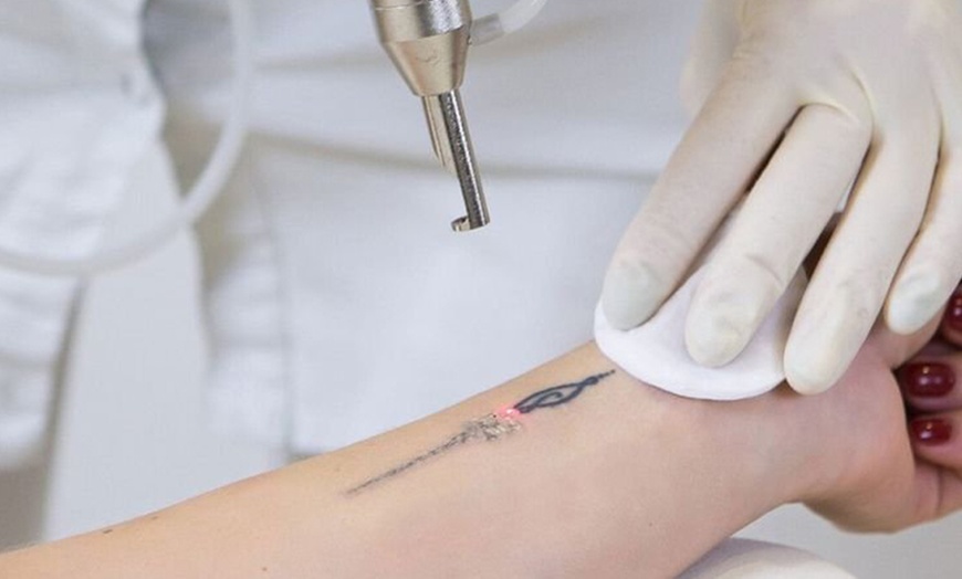 Image 2: 1, 2, or 3 Laser Tattoo Removal Treatment Up to Nine Square Inches