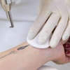 Image 2: 1, 2, or 3 Laser Tattoo Removal Treatment Up to Nine Square Inches