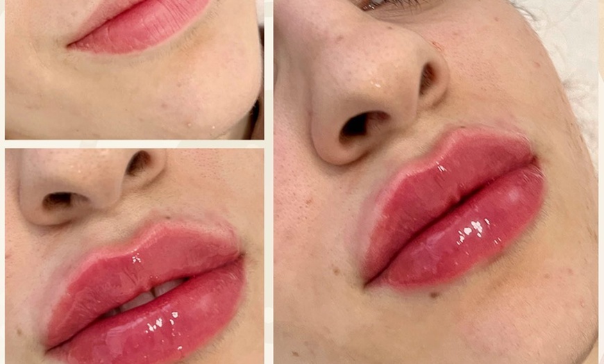 Image 2: 0.5ml Dermal Filler