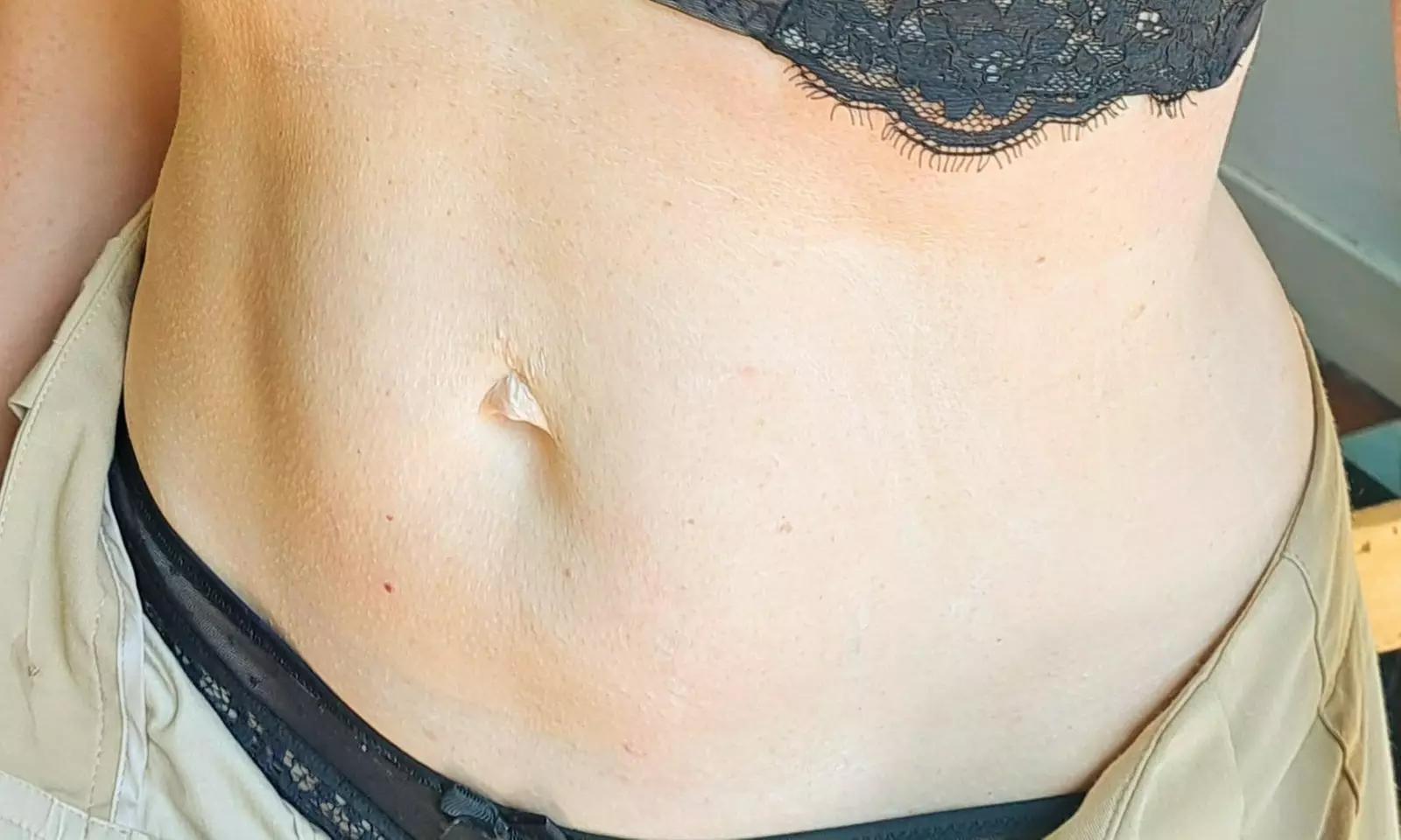 Afslanken & verstevigen met Hifu 12D - 22D behandeling naar keuze