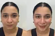 Tratamiento reafirmante inyectado en 3 zonas faciales con opciones extra para 1 persona, ahorra hasta un 53% - Second Medium