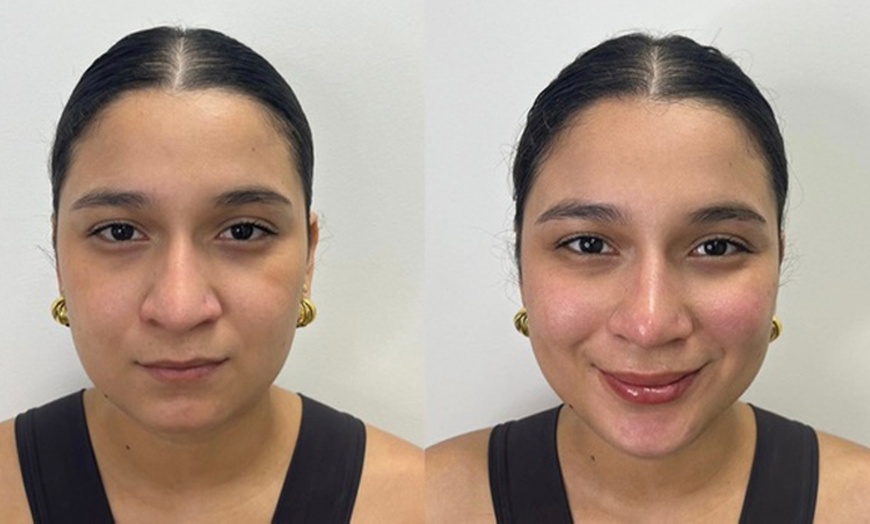 Image 2: Infiltración de toxina efecto lifting facial con opciones extra para 1