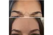Smooth & Refreshed with 20, 40 or 60 Units of Xeomin at the GLO suite Up to  38% Off - Second Medium