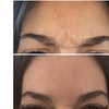 Image 2: Smooth & Refreshed with 20, 40 or 60 Units of Xeomin at the GLO suite 