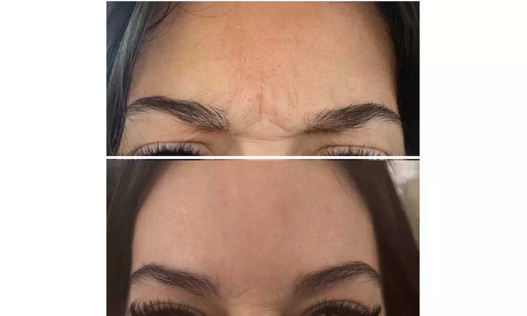 Smooth & Refreshed with 20, 40 or 60 Units of Xeomin at the GLO suite 
