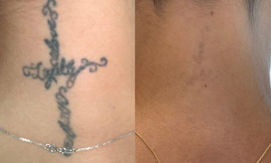 Image 3: Three Sessions of Laser Tattoo Removal: Small, Medium, or Large Area