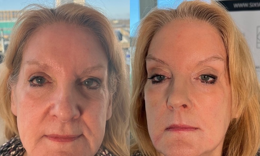 Image 6: Revitalize with 1ml, 2ml, or 3ml Dermal Fillers for Cheek, Jaw or Chin