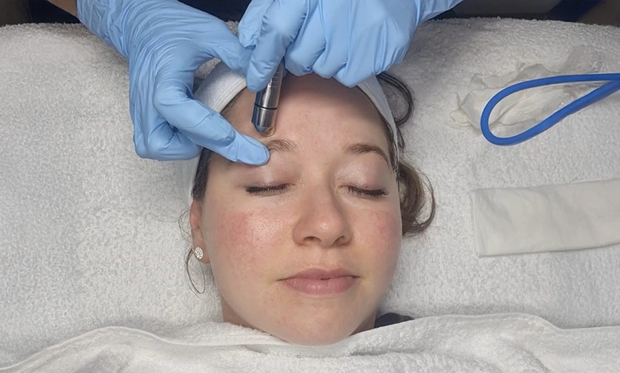 Image 1: One Microdermabrasion or Fill Up 360 Microneedling with LED Therapy!