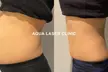 Fat Freezing Treatments on One or Two Area at Aqua Laser Clinic Newtown (Up to 90% Off) - Image 2