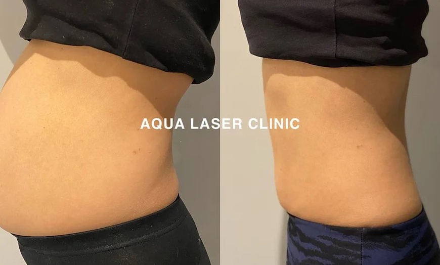 Image 2: Fat Freezing Treatments at Aqua Laser Clinic Newtown