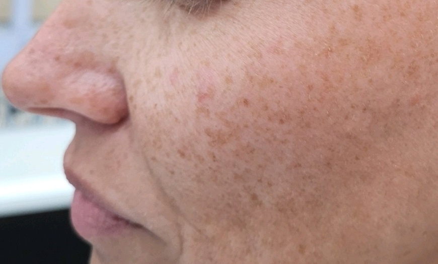 Image 1: Revitalize Your Skin with IPL Photofacial Treatments
